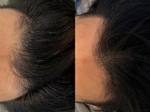 カフネスカルプケアルーム(CAFUNE SCALP CARE ROOM)の雰囲気（頭皮専用のLEDライト、頭皮毛穴洗浄もご準備しております。）