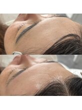 アイルーム 大宮店(eyeroom)/おでこの脱毛も大人気です！