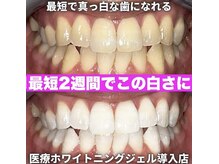 ホワイトサロン/スピードホワイトニングで1日