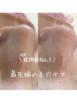 ビジュープラス ひたち野うしく店(Bijou+)/茨城県施術数/症例数No.1