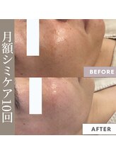 メリーオーシャンズ(merry ocean’s)/毛穴洗浄×シミケア　10回目症例