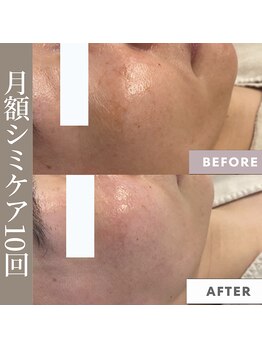 メリーオーシャンズ(merry ocean’s)/毛穴洗浄×シミケア　10回目症例