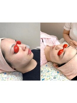 顔脱毛がしたい