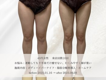 エメ 名古屋栄店(aimer)/BodyCare <痩身・代謝アップ>