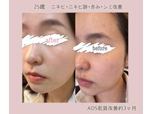 プティ カシェット 伊丹店(petit cachette)/ADS肌質改善ビフォーアフター2★