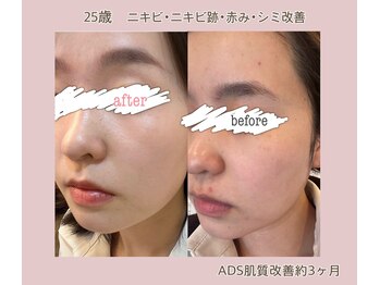 プティ カシェット 伊丹店(petit cachette)/ADS肌質改善ビフォーアフター2★