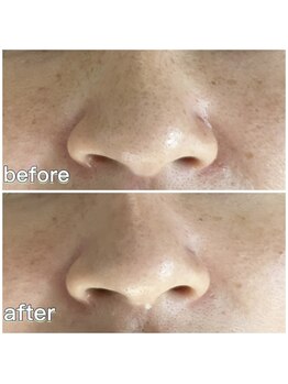 ミラ 中央林間(mira)/小顔　毛穴　ホワイトニング