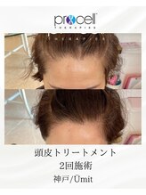 ユミト(Umit)/プロセルスカルプ