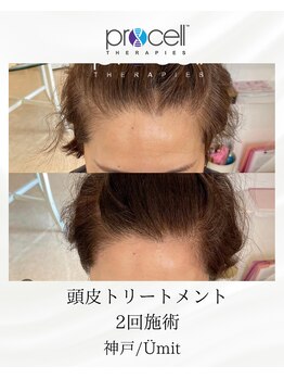ユミト(Umit)/プロセルスカルプ