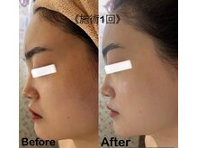 マスカレード(Masquerade)/【症例写真】ララピール