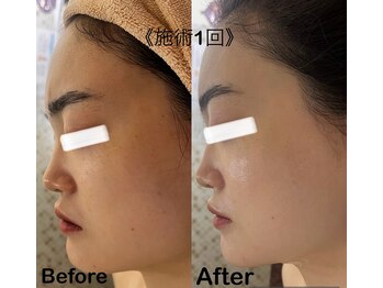 マーレン(Malen)/【症例写真】ララピール