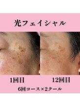 ルアージュ 狭間店/光フェイシャルおシミに効果的♪