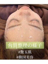 セレブリボーン 大阪ボーテ/韓国肌美容「角質整理」の様子