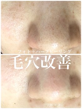 リリアーナ(LILIANA)/ハーブピーリングで毛穴ケア