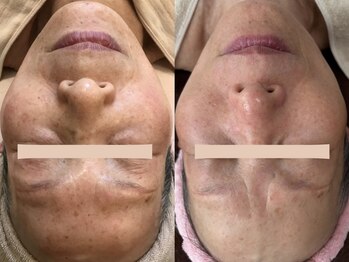 サロンドミュウ(Salon de Mieux)/【シミ】でお悩みのお客様