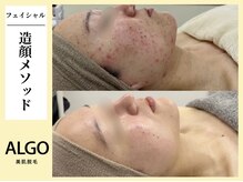 アルゴ 飯塚店(ALGO)/造顔メソッド