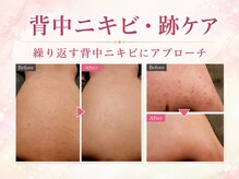 プライベートエステサロン トゥインクルの雰囲気（【針状ハーブピーリング】背中や顔のニキビ・跡ケア・毛穴改善◎）