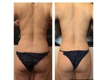 カロン(Kalon)/痩身