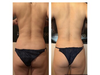 カロン(Kalon)/痩身