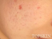 トップスキン 久屋大通(TOPSKIN)/希少な国産天然ハーブ100％使用