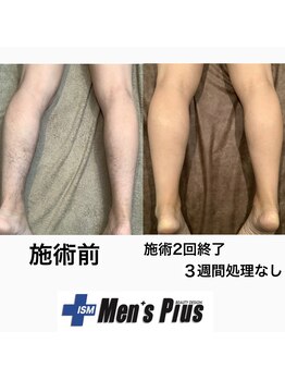 メンズプラス(Men's Plus)/【施術事例】