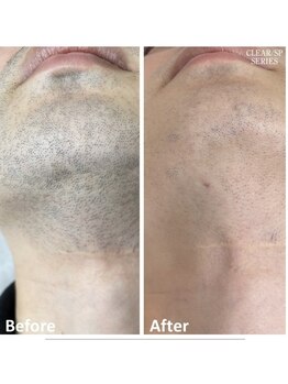 スプレール 水戸店/髭脱毛