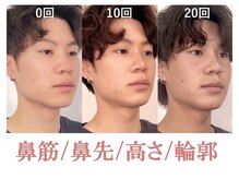 ラプリ 盛岡店(Raplit)/隆鼻＋輪郭矯正40分20回
