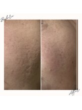 イチロクイチハチ(1618)/ニキビケアもお任せ下さい