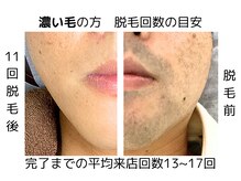 イチキュービー 仙台駅前東口店(19B)の雰囲気（【濃いひげ】平均回数13～17回　圧倒的効果で毛が生えてこない!）