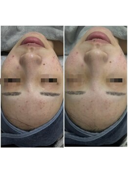 ファーファラ(Farfalla)/ハーブピーリング