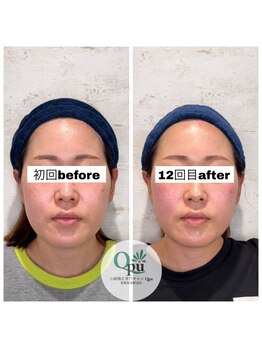 キュープ 相模原淵野辺店(Qpu)/たった4回で人生で1番小さな顔に