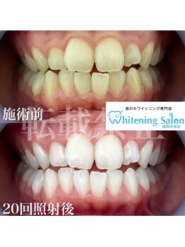 ホワイトニングサロン 福岡天神店/ホワイトニング
