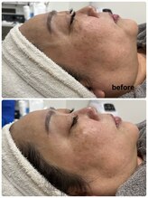 ウェイビーズ エステ(wavy's.esthetic)/【ビフォーアフター】ツヤ美肌