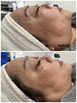 ウェイビーズ エステ(wavy's.esthetic)/【ビフォーアフター】ツヤ美肌