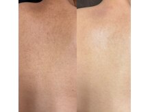 【ハーブピーリング/毛穴洗浄/小顔リフト】total beauty salon mayahime 大宮店の雰囲気(お背中も大人気のREVIハーブピーリングオプション全て揃ってます)