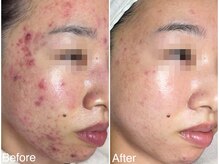 《ニキビケア》悩んでいた期間:8年:ケア15回6か月の変化