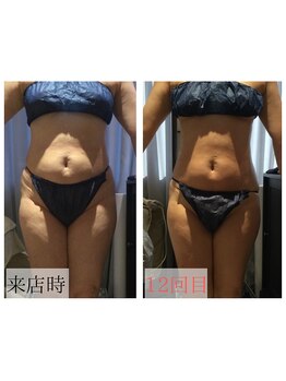 アンジュ(Ange)/セルゼロで綺麗なボディメイク★