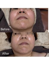 エシャーム(echarme)/毛穴の引き締め＆たるみケア