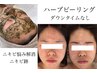 ハーブピーリング【お悩み　ニキビ】¥34650→¥9800