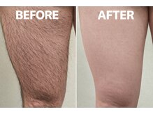 フォーツー 荻窪店(42)/脱毛　太もものビフォーアフター