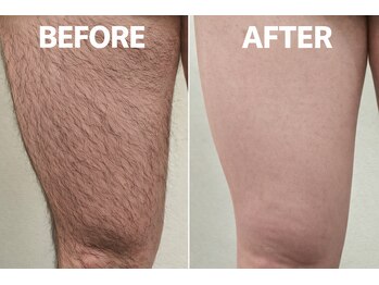 フォーツー 荻窪店(42)/脱毛 太もものビフォーアフター