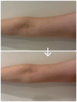 Kino Beauty Salon二子玉川店 ローマピンク/ホワイトラボ/脂肪冷却/シミ/メラニンケア/脂肪冷却