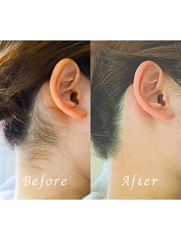 ララリア(LaLaLia)/うなじWAX脱毛