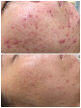 アンジェロ/【ニキビケア】肌育プログラム