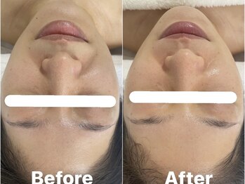 ルーナ 恵比寿(Luna)/サーマルW小顔ケア 透明感ハリ艶