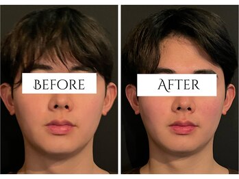 クク 赤坂 天神(99 KUKU)/【メンズ】【美容鍼】