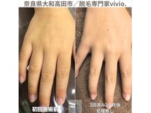 ヴィヴィオドット(vivio.)/手の指脱毛／指毛脱毛