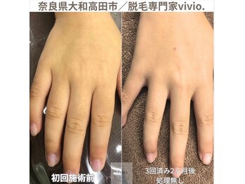 ヴィヴィオドット(vivio.)/手の指脱毛／指毛脱毛
