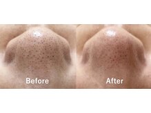 アンヘル(Angel)/毛穴洗浄ビフォーアフター