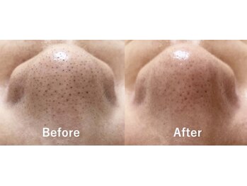 アンヘル(Angel)/毛穴洗浄ビフォーアフター